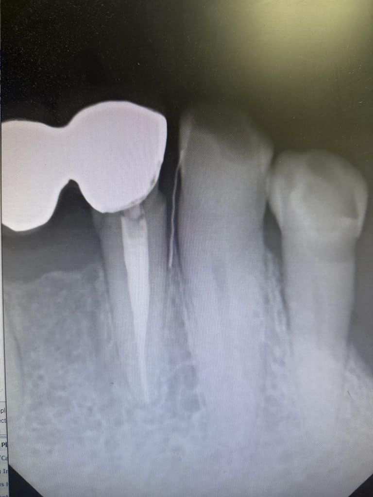 Grill Brush and Scraper Bristle Free - Safe BBQ Brush for Grill - 18'' Stainless Grill Grate Cleaner - Safe Grill Accessories for Porcelain/Weber Gas/Charcoal Grill - Gifts for Grill Wizard customer photo 1